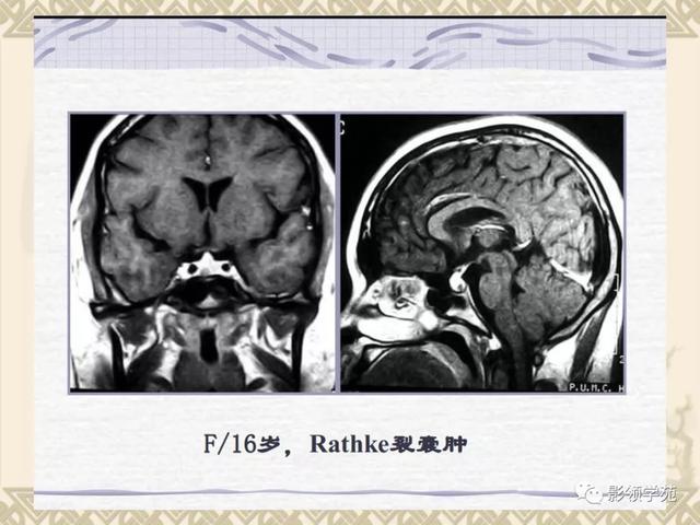 垂体病变的MRI诊断