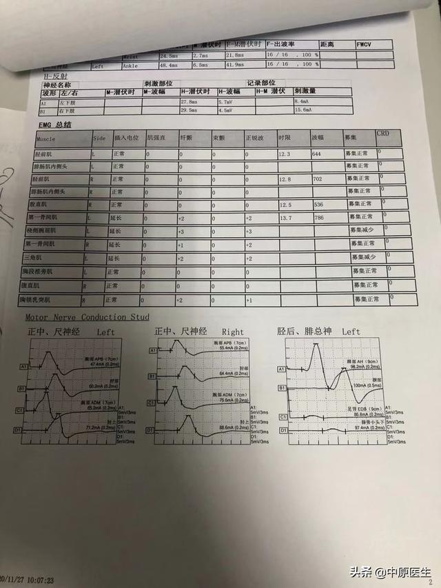 60岁女子四肢无力按脑梗塞治疗一年无效，被省级专家确诊渐冻症