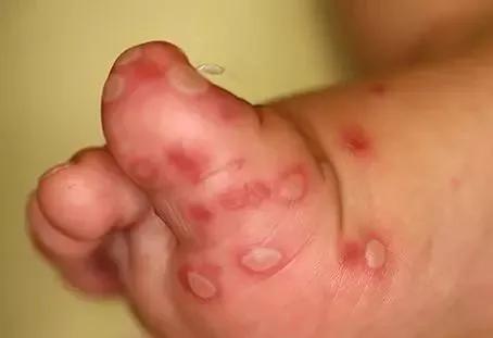 逗比大家庭|疱疹性咽峡炎又到高发期！别与手足口病、口腔溃疡搞混了