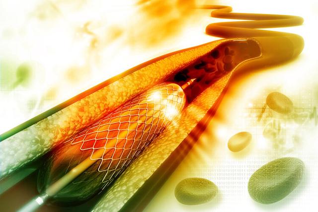 一年间被放入4个支架！胡大一直言：别让心脏支架变过度医疗