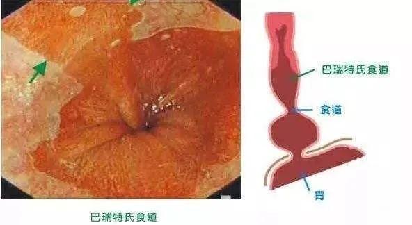 食管|科普知识丨巴雷特食管，和武器同名的它，真那么可怕吗？