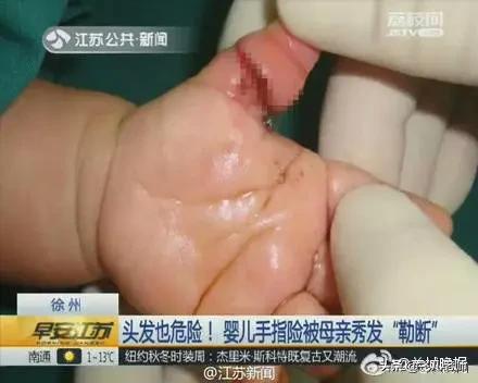 超级宝妈@2月龄宝宝差点被截肢，原因竟然是我们意想不到的东西