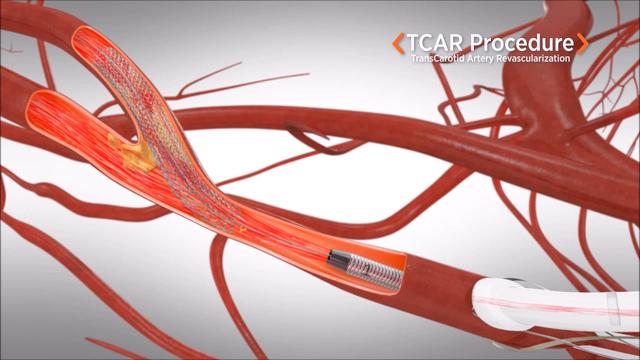 医生：颈动脉狭窄易引起脑梗塞，怎么办？什么时候手术？请看此文