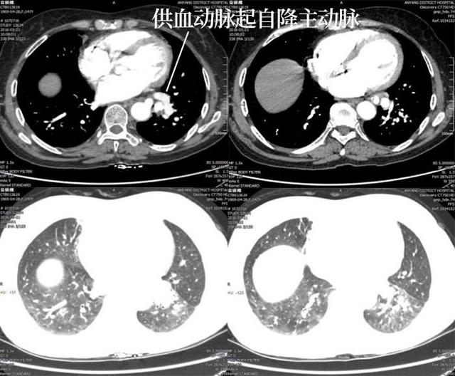 一起来了解肺隔离症 CT 影像表现