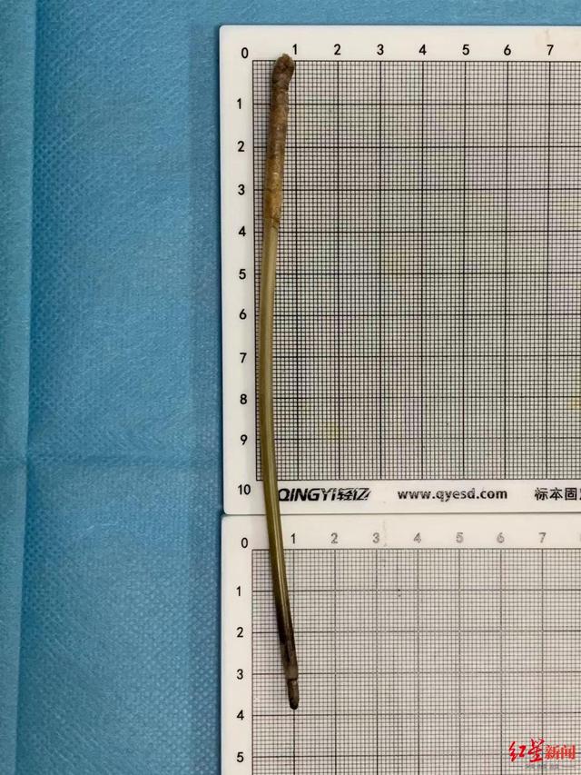 患者|女子腹痛难忍就医，CT检查发现体内竟有1