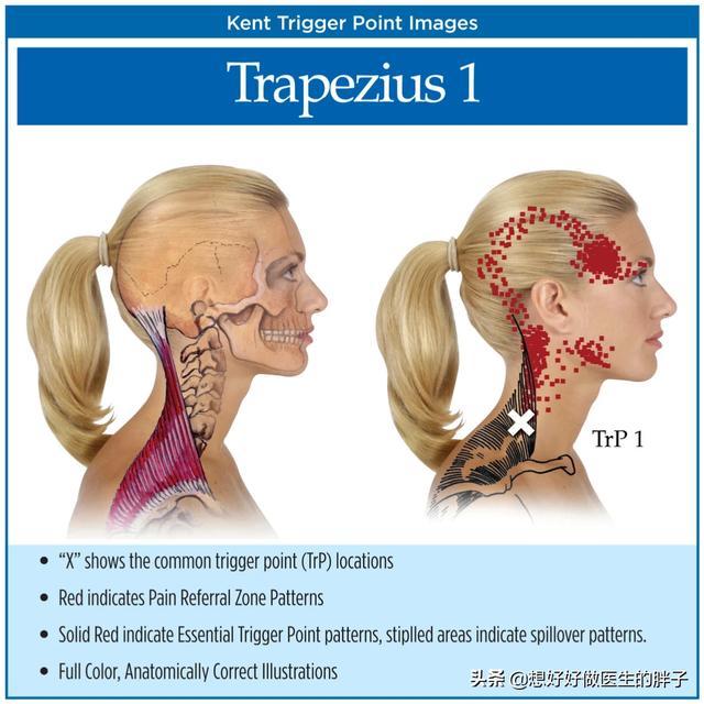 斜方肌|斜方肌在哪？为什么有那么多人这个肌肉会痛？应该如何缓解治疗呢