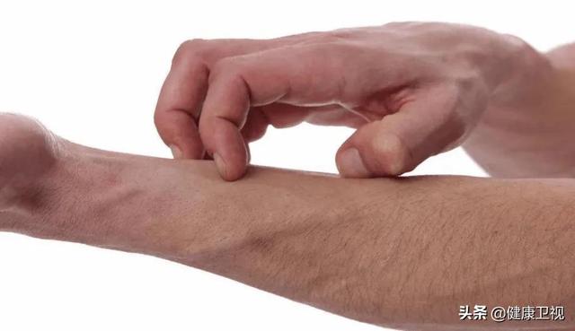 荨麻疹|痛还能忍忍，但痒起来真受不了——荨麻疹的艾灸妙招