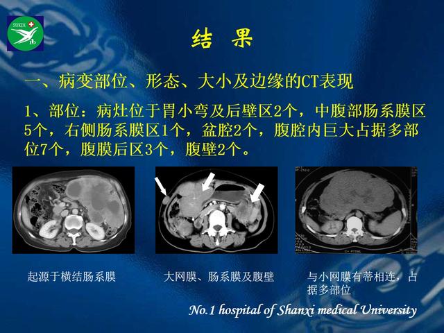 李健丁教授：胃肠道外间质瘤的CT表现和临床病理分析