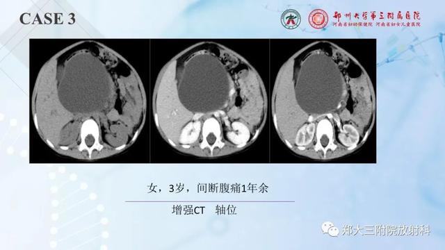 儿童腹部囊性病变诊断思路分析