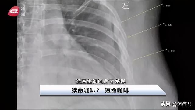 30岁女白领咳嗽断了3根肋骨，医生：骨头比60岁老人还脆