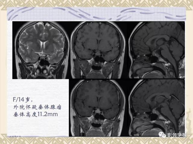 垂体病变的MRI诊断