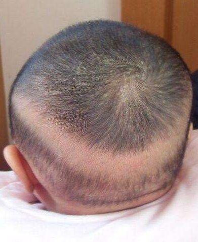 超级宝妈■90%的婴儿有枕秃,正常吗?