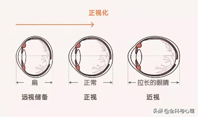 近视防控—幼儿园篇