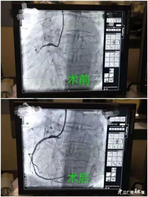 心脏支架降到几百块正式落地到九江了！九江学院附属医院正式执行国家组织冠脉支架采购结果