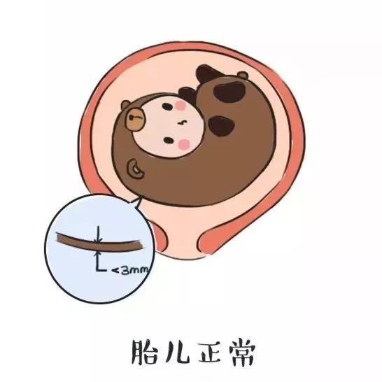 「你的育儿经」NT什么时候做？正常值是多少？看完你就明白了!