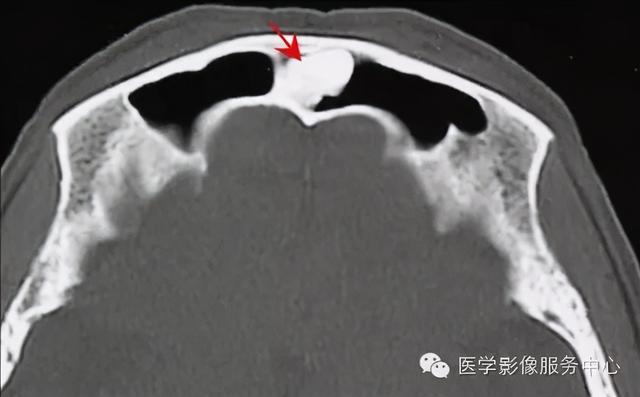 77种骨肌影像病例，助你诊断无忧