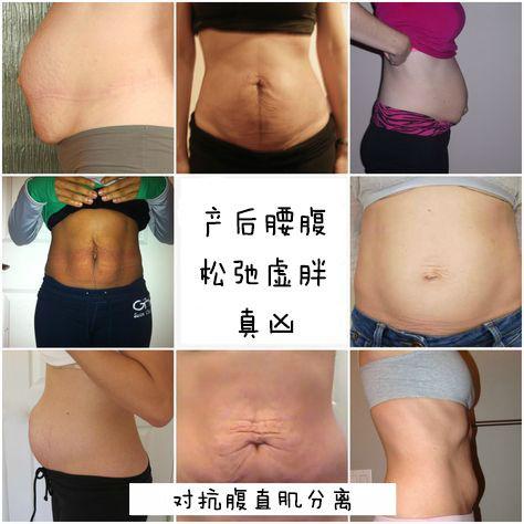 南浔的梦|孕前小蛮腰，产后变肉包，那是因为你的腹直肌分离了