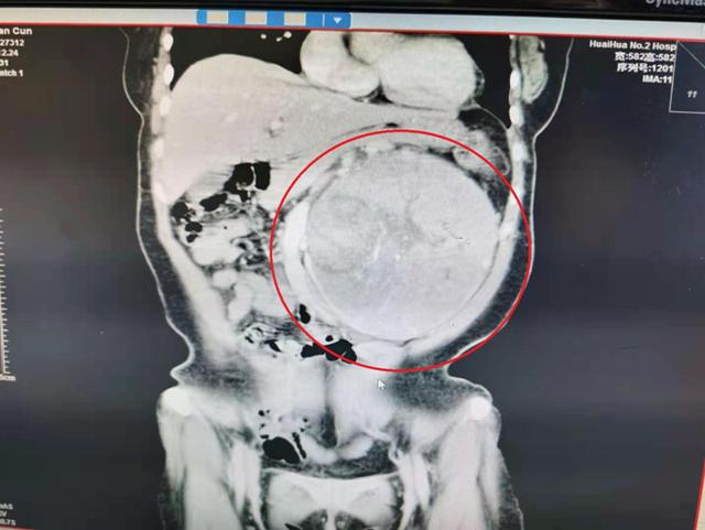 足球样大肾脏肿瘤，怀化二医团队这样轻松拿下