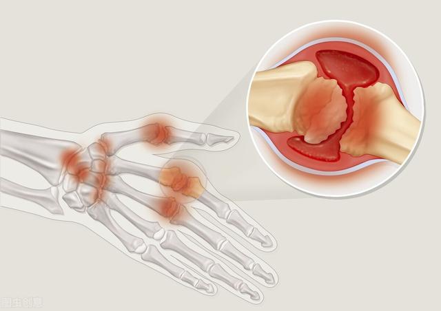 关节痛就是类风湿？别随便给自己“扣帽子”！4个特征对照看下