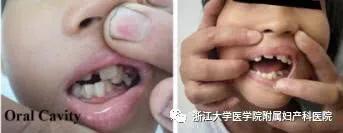 「你的育儿经」崩溃!正常夫妻连续生2个智力障碍孩子,又怀了第三胎!