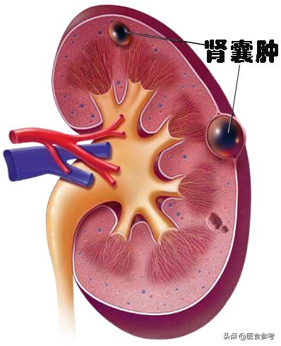 结节、息肉、囊肿、增生...哪个最可能癌变？这么多年疑惑终于解开了！