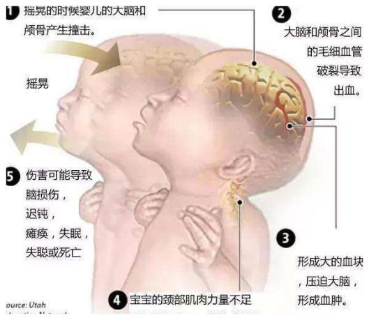 “摇晃”式哄娃儿暗藏的危险——您知道吗？