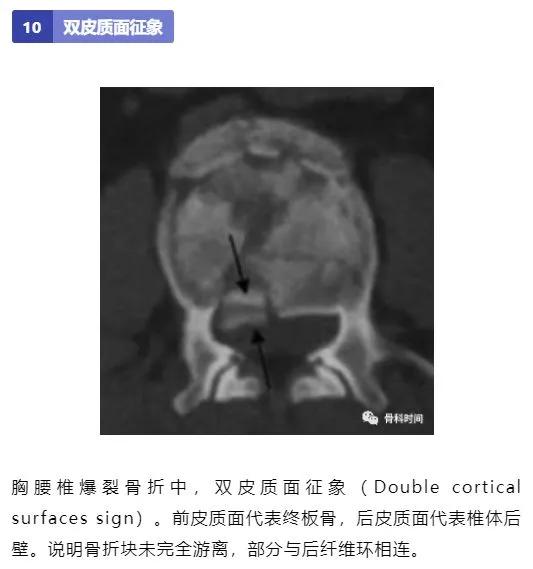 影像经验！脊柱的 13 个影像学特征