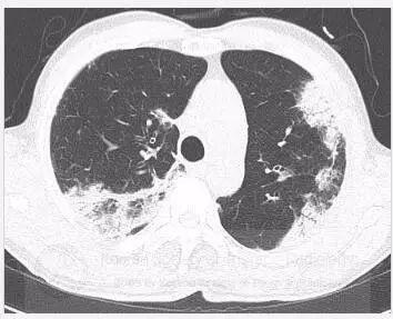 患者无特异性症状，双肺斑片状实变的原因是？丨以影识病