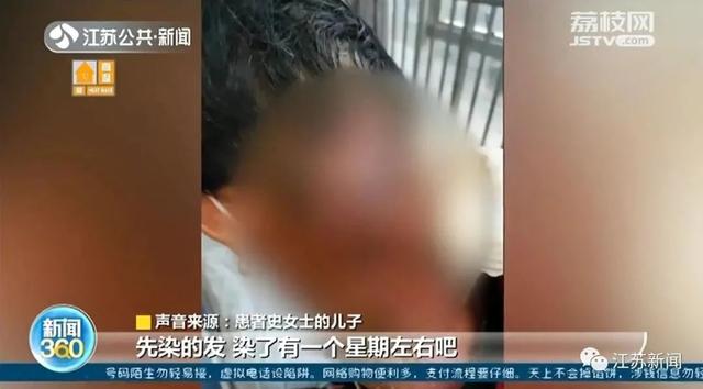 女士|染发有风险！女子染发致头颈部大面积感染