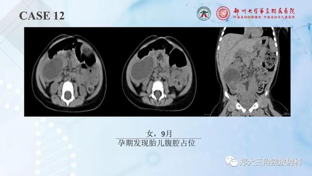 儿童腹部囊性病变诊断思路分析