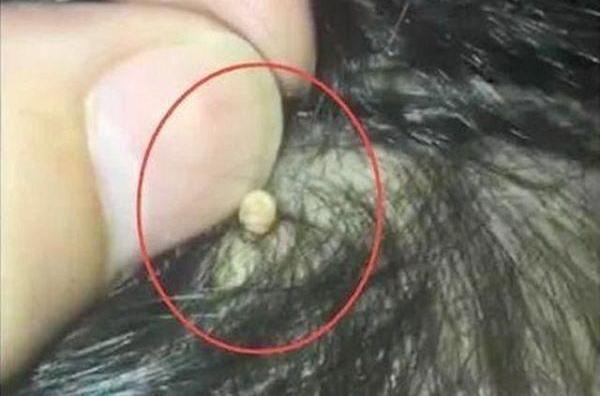 超级宝妈▲妈妈发现女儿头上有小米粒，医生：再晚点来就秃了