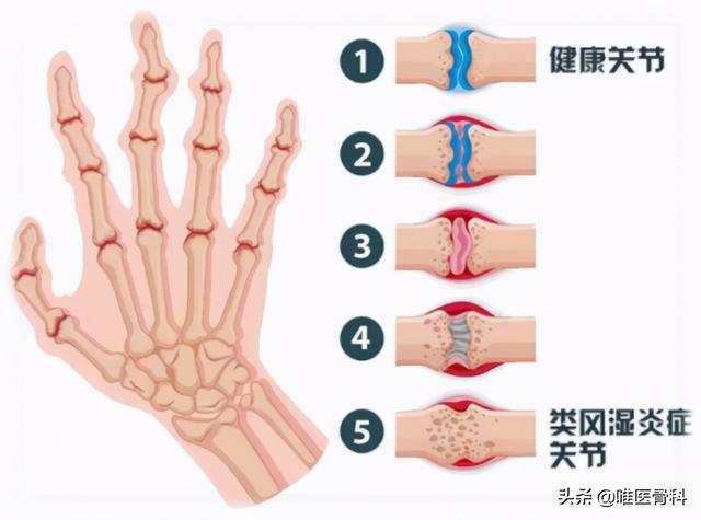 3 个方法，帮你判断是否得了「类风湿性关节炎」