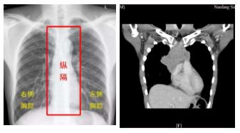 28岁男子反复咳嗽竟因患了这个病，其后凶险接踵而至