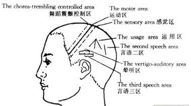 摆脱半身不遂，针灸来帮忙