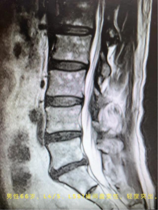 有一种“腰椎间盘突出症”，其实是颈椎病！