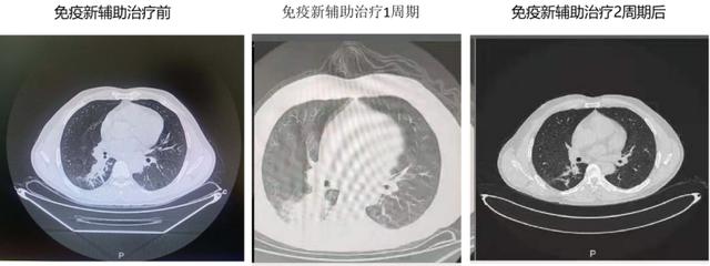 百例之约 | 新辅助免疫治疗后肿瘤增大？假性进展！继续用药后肿瘤缩小，且术后pCR