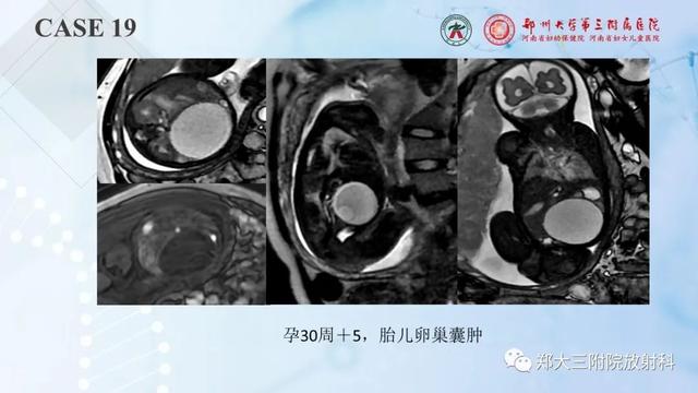 儿童腹部囊性病变诊断思路分析