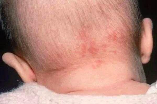 [你的育儿经]孩子身上出现这些颜色，是健康警报，却总被忽视