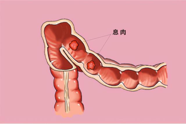 结节、息肉、增生，哪些“病块”会癌变？