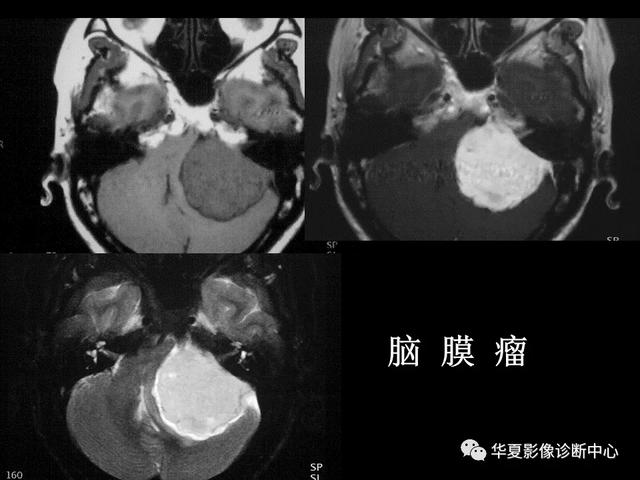 「影像复习」脑干区常见病变影像表现