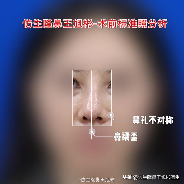 【超级宝妈】鼻尖不好看的宝宝们请看过来