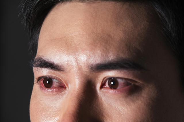 用眼不当，小心结膜炎找上你！要预防结膜炎，日常需注意6点