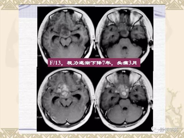 垂体病变的MRI诊断