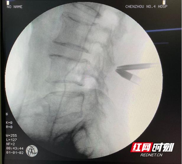 手术|郴州市第四人民医院成功开展单侧双通道脊柱内镜技术治疗腰椎管狭窄症