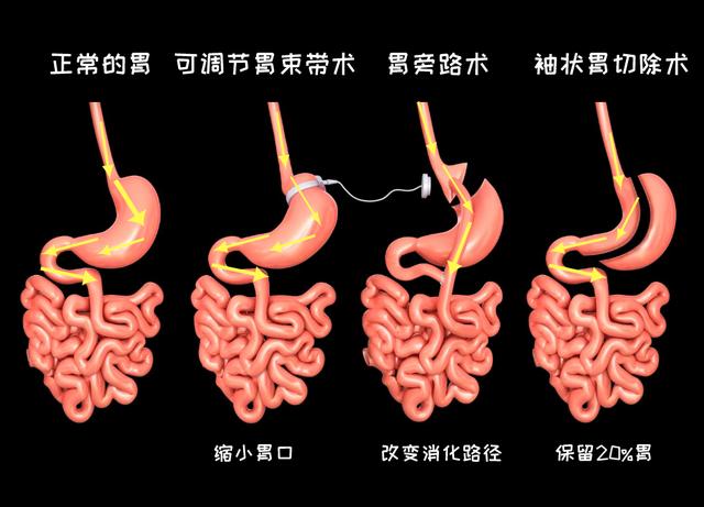 减重速度:胃旁路术 > 袖状胃切除手术 > 可调节胃束带术 并发症:胃