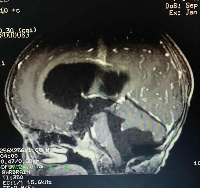 [南方都市报]5岁男童脑袋里长个鸡蛋大的肿瘤！孩子出现行走不稳症状要警惕