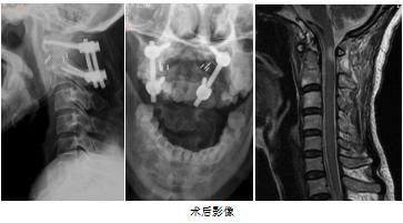 寰枢椎|莆田：这项新技术让&amp;#34;手术禁区&amp;#34;变&amp;#34;通途&amp;#34;