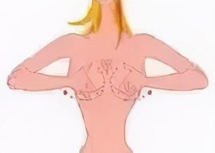 “乳腺增生”怕刮痧，多刮刮就好了