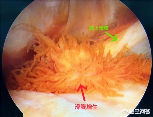 内侧半月板|为什么走平路膝关节不疼，但是打弯、下楼梯、蹲起时膝关节疼痛呢