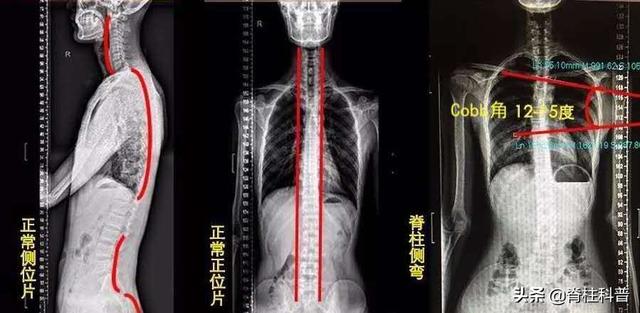 宝妈宝爸，需要GET到这项技能---如何发现孩子是否有脊柱侧凸？